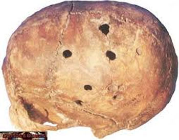 Cráneo encontrar en Berzahom con evidencia de cirugía craneal