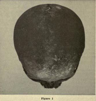 A brachycephalic Red Ocher skull, Wisconsin Archaeologist. 