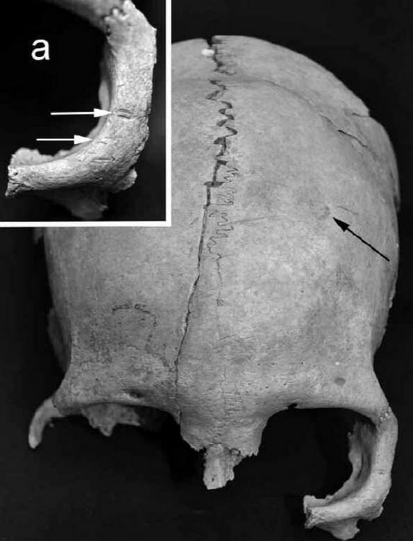Uno de los cráneos decapitados mostrando sanados traumatismo craneal: (a) primer plano de marcas de corte alrededor de la órbita del ojo.