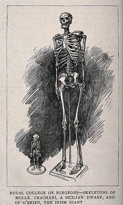 Sketch depicting skeletons of a male giant and a female dwarf, displayed at the Royal College of Surgeons.