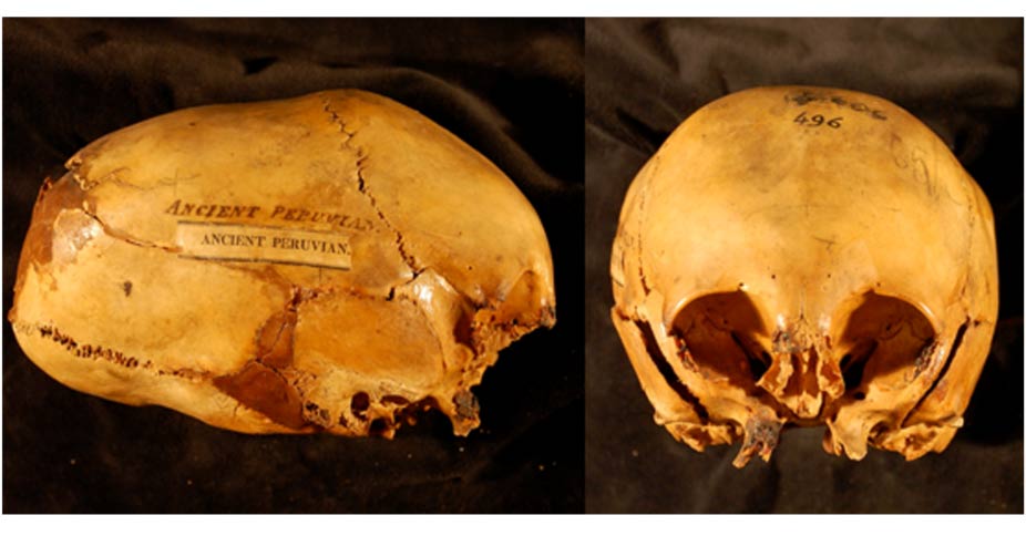 Elongated Skulls in utero - Morton Collection
