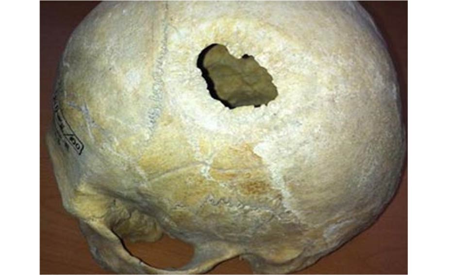 Cráneo del varón con la trepanación, que tenía una deformación hereditaria del cráneo