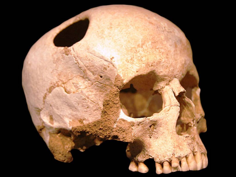 Un cráneo trepannated del Neolítico