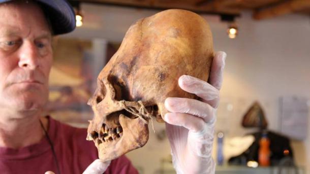 Brien Foerster with an elongated skull