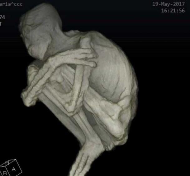CAT scan image of the body 