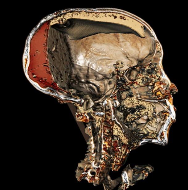 CT imaging shows a detailed view of King Tut’s mummified skull – including the resin embalmers filled it with.