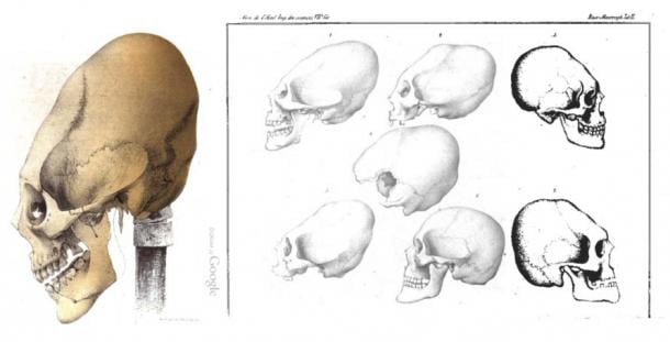 Elongated Skulls in utero: A Farewell to the Artificial Cranial Deformation Paradigm? Elongated-Skull-from-Crimea