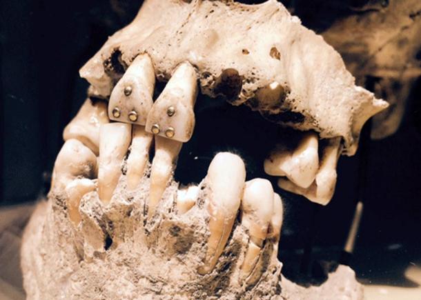 Gold studded teeth, Pre-Columbian Ecuador.