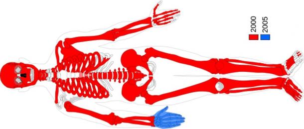 Moora’s recovered body parts. Red parts were found in 2000 and blue parts were found in 2005 at Uchter Moor near Uchte, Lower Saxony, Germany. Dating to 764 -515 BC.