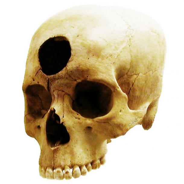 A Nazca-Peruvian skull operation from 2000 years ago presumably to relieve a front cavity inflammation. 