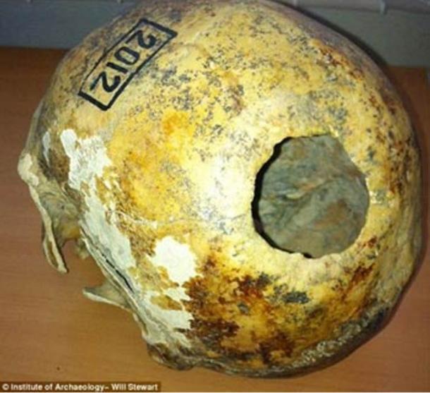 Cráneo del hombre de mediana edad con pruebas de trepanación que se encuentra en las montañas de Altai de Siberia