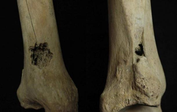 First example of ancient surgical drilling technique on bones which aren’t skulls.