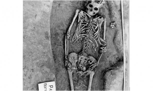 Researchers said the bones of this woman's twin fetuses are visible near her pelvis and thighs