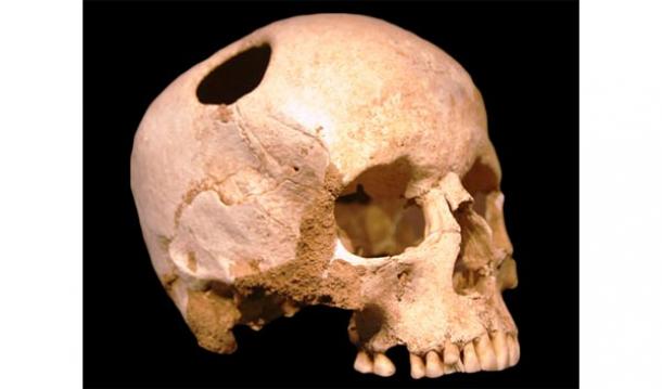 Los antiguos nómadas Pazyryk - Cirugía Craneal