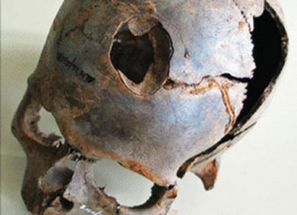 Uno dei reperti provenienti dal sito include questo teschio umano con un grande frattura. 