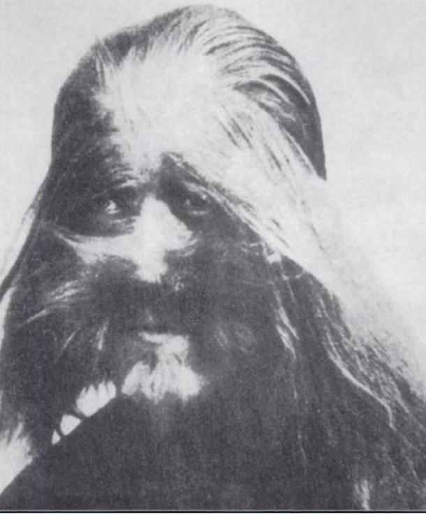 A photo of Li Baoshu who was born with the condition hypertrichosis, also known as “werewolf syndrome,” that causes excessive hair growth. The picture was on display at Beijing’s zoo in the 1920s.