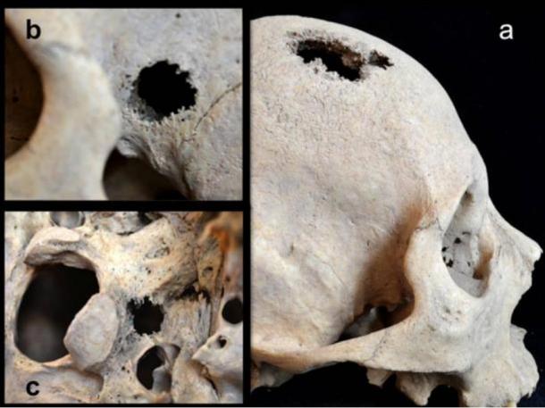 Lesions and holes in the skull of the Siberian man suggest people suffered cancer in the Early Bronze Age period