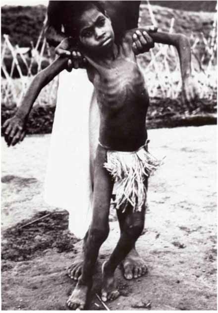 Child from the Fore tribe suffering from advanced Kuru, which was later connected to their practice of cannibalism. (Liberski PP / CC BY 3.0)