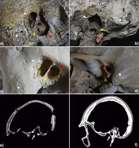 Tomografías computarizadas (cyd) de los huesos temporales del cráneo (ayb) que fueron intervenidos de oído hace más de 5.000 años en España. (Informes científicos)