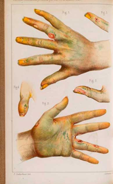 Damage caused by the use of green arsenic, 1859, from Scheele’s Green pigment. (Fæ / CC BY-SA 4.0 )