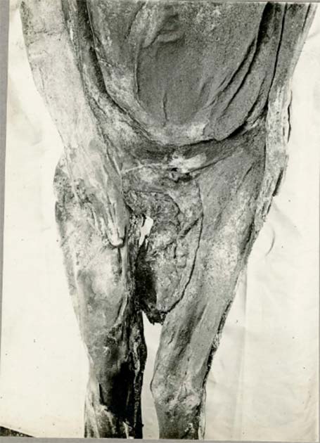 Görüntü, 1908'de bulunduğunda fetüsün bandajlara sarıldığını ve annenin vücudunun açıldığını gösteriyor. (Francine Margolis, David R. Hunt / çevrimiçi kütüphane. wiley. com)