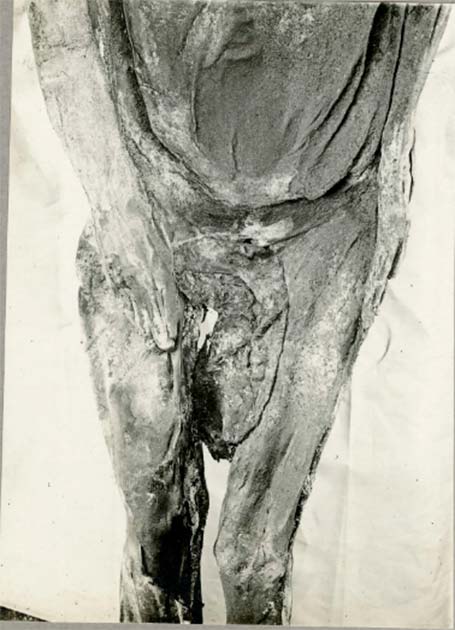 Teenage Mummy Found with Fetus Trapped in Her Pelvis Shows Harsh Reality of Childbirth