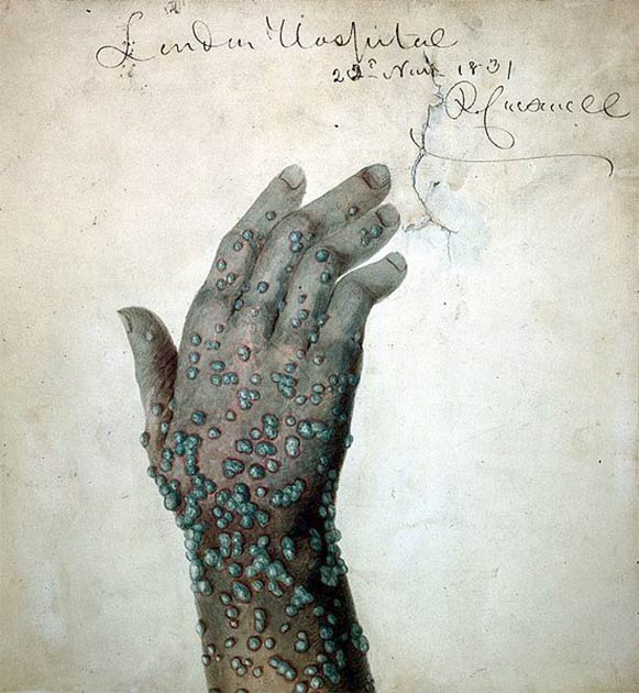 Smallpox was an infectious disease that killed around 300 million people in the 20th century alone, before it was officially eradicated in 1980 thanks to a global vaccine. (Robert Carswell / CC BY 4.0)