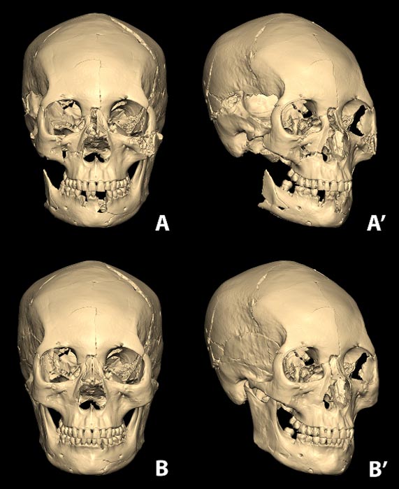 The assembled skull from the osseous fragments utilizing computerized 3D modelling program (A and A'). The completed restoration of the skull from damaged/missing parts (B and B').