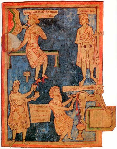 Miniatura inglesa del siglo XI. A la derecha, una operación para extirpar hemorroides. A la izquierda, un paciente con gota es tratado con cortes y quemaduras en los pies. (Dominio publico)