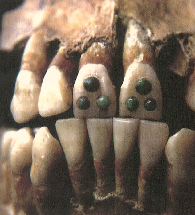 An example of a Maya teeth featuring a gemstone in inlay modification. (Emmashavrick / CC BY-SA 4.0)