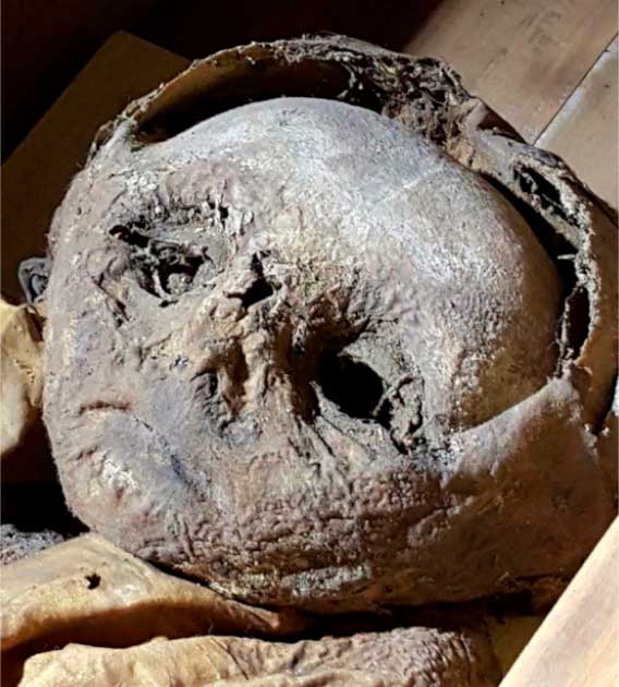 Detail of mummy's face.  Note here the skin imperfections on the chin and nose and the gap between the frontal bone and the silk hood.  (Frontiers in Medicine)