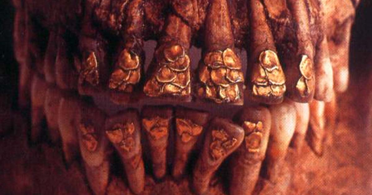 Gold inlaid teeth of the Bolinao Skull.  Source: National Museum of the Philippines