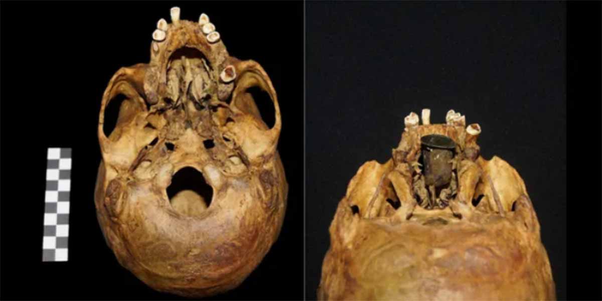 „Niezwykły” 300-letni wyrób protetyczny wykonany ze złota i miedzi odkryty w Polsce