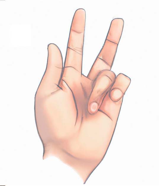A ring finger locked in a bent position as seen in Dupuytren's disease, colloquially known as “Viking’s disease.” (Hugo Zeberg / Molecular Biology and Evolution)