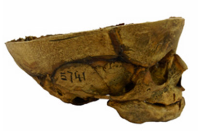 The only foetal skull in the Cambridge to have undergone a craniotomy.