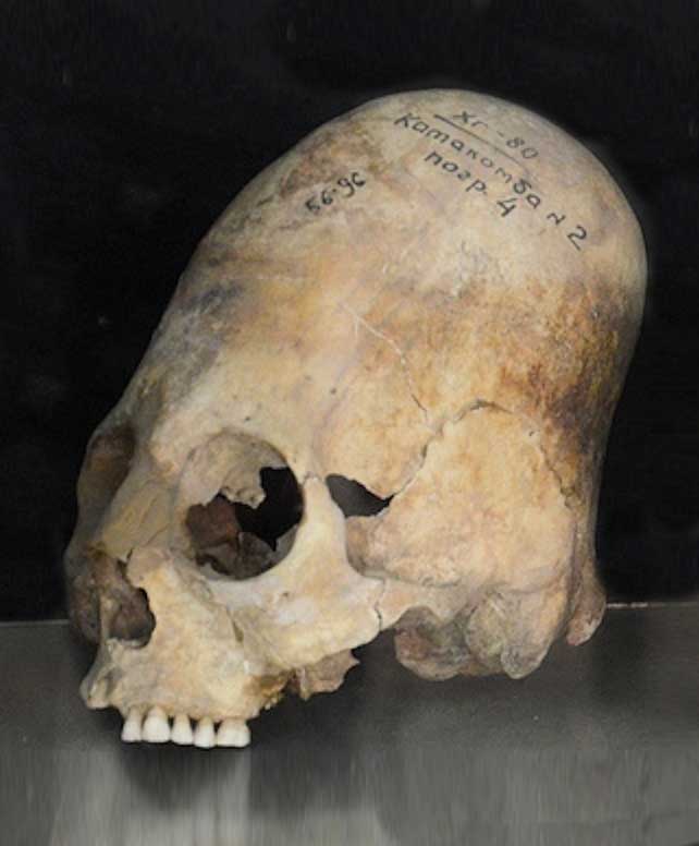 Example of artificial cranial modification from the Neolithic period. 