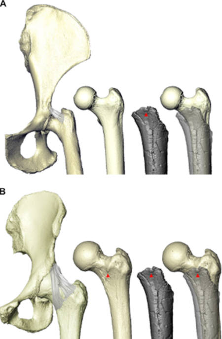 The femoral tubercle of Sahelanthropus