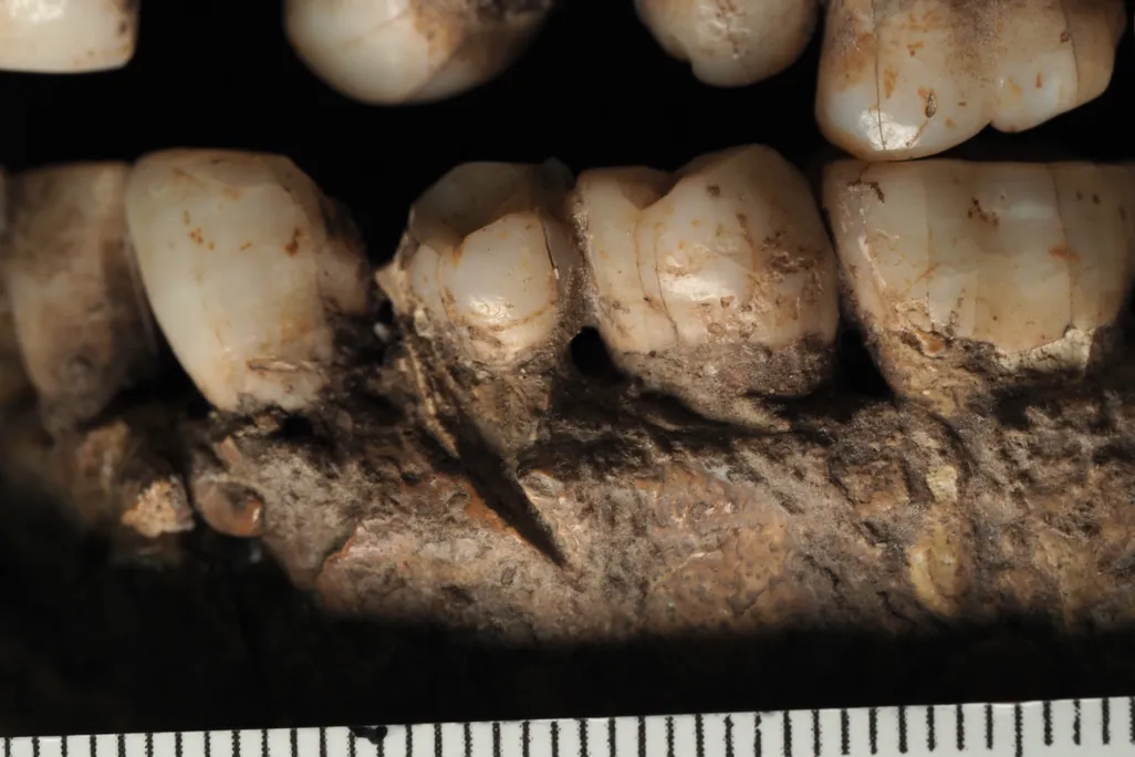 Close-up of the healed sharp-force injury on the left mandible of the Qafzeh 25 individual from Qafzeh Cave, Israel. Bone remodeling around the lesion indicates the early Homo sapiens survived the injury, making it one of the oldest known healed facial wounds in the archaeological record