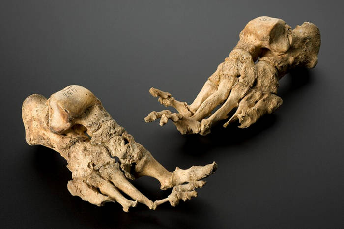 Leper victims skeletal feet.