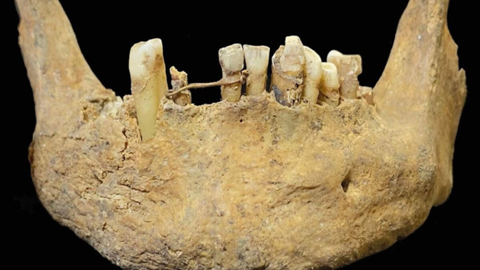 Gold wire ligature on the mandible of the medieval man found at St Nicholas Kirk, Aberdeen
