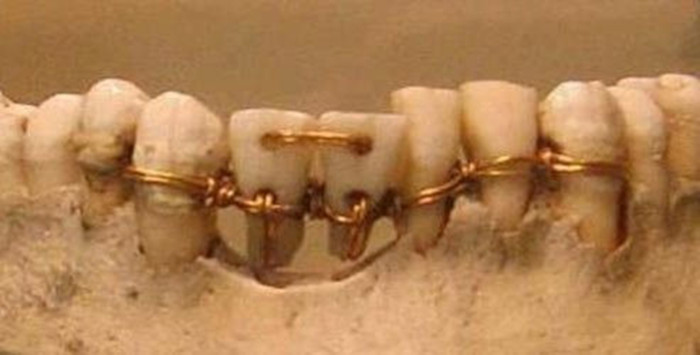 A photo of ancient dental bridge techniques