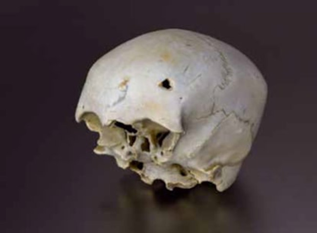 Skull of a woman with a frontal fracture found in the Bay of Cádiz.