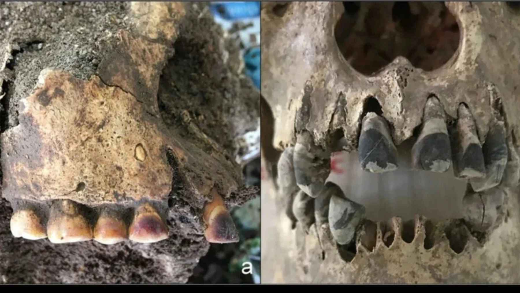 Iron Age skulls from the Dong Xa site in Vietnam show evidence of blackened teeth