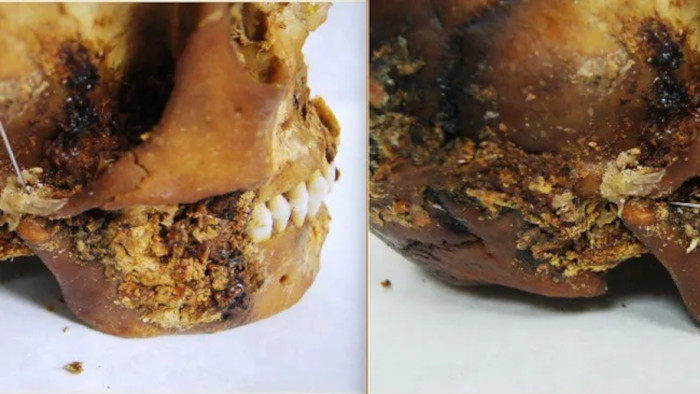 The area of the jaw where the evidence of surgery was found.