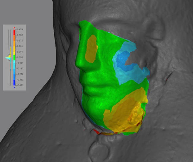 The mask reference surface is shown in gray, while the aligned fragment is colored based on the surface-to-surface distance at each point
