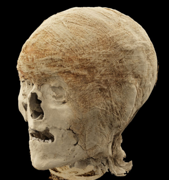 A mummified head examined at Semmelweis University using photon-counting CT technology.