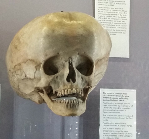An anatomical specimen of a 25-year-old human skull showing extreme enlargement due to severe hydrocephalus.
