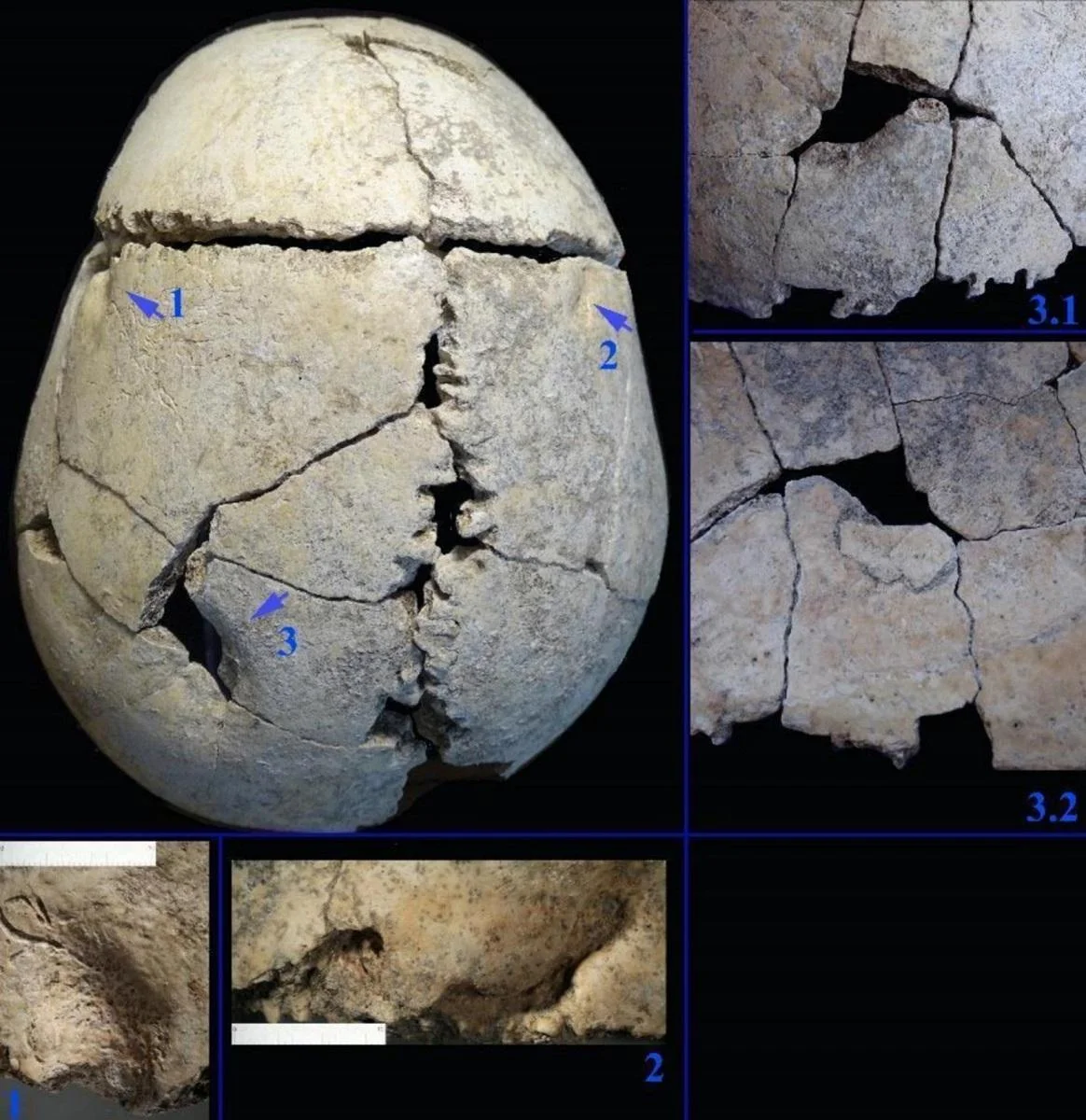 Reconstructed skull shows the evidence of the attack.