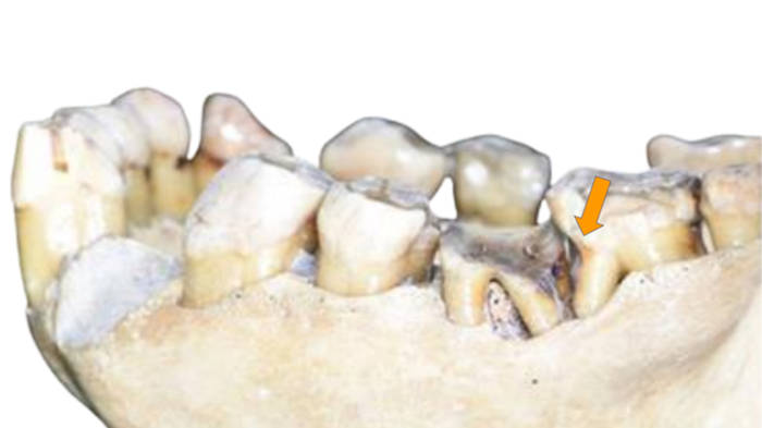 Orangutan mandible (Pongo pygmaeus) with a ‘toothpick groove’ on the lower left second molar (specimen FMNH 19026; Field Museum Chicago). An orange arrow indicates the position of the groove.