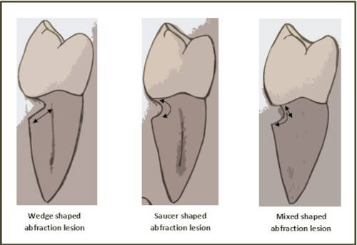 Antik Dişlerdeki İzler